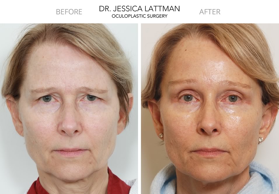 Female Blepharoplasty and Brow Lift by Dr. Lattman NYC