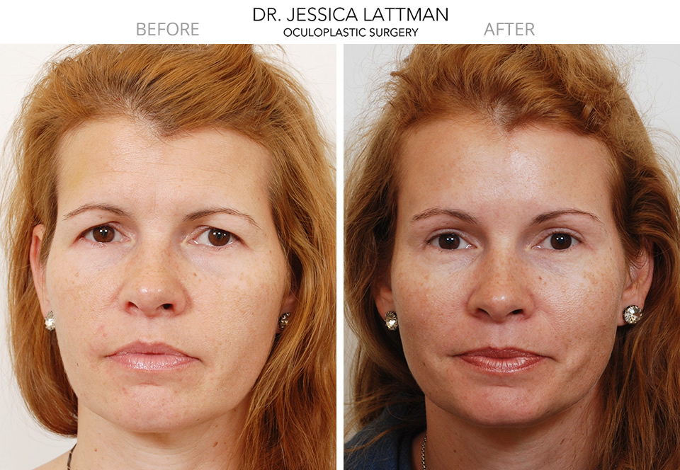 Female Brow Lift and  Blepharoplasty by Dr. Lattman NYC
