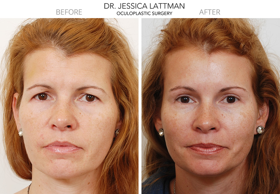 Female Blepharoplasty by Dr. Lattman NYC