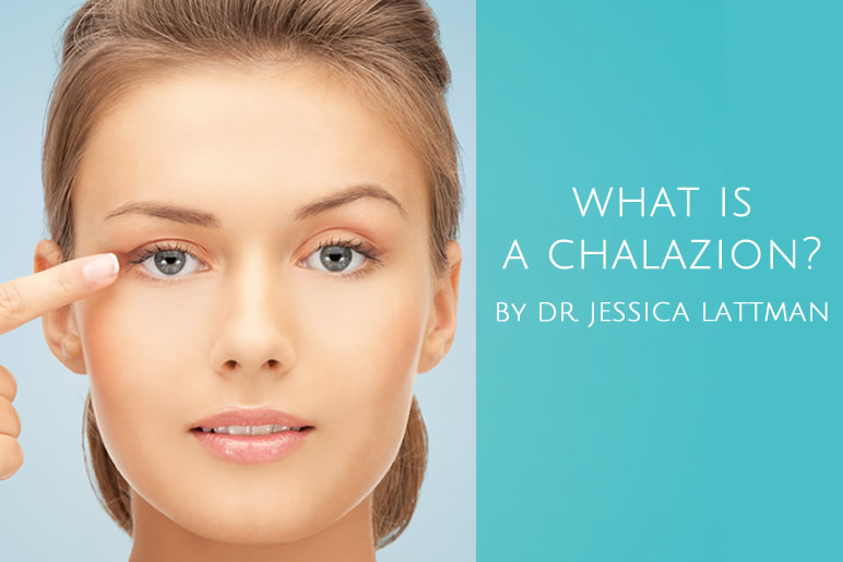 What is a Chalazion
