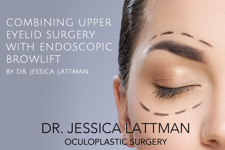 Combining Upper Eyelid Surgery with Endoscopic Browlift