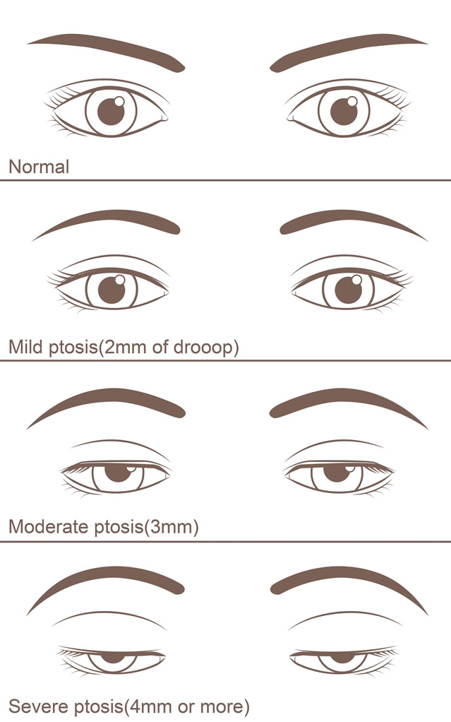 Stages of Ptosis