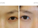 Asian Blepharoplasty Gallery