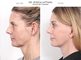 Blepharoplasty 