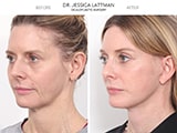 Blepharoplasty 