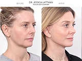 Blepharoplasty 
