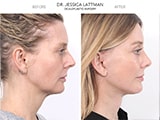 Blepharoplasty 