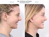 Blepharoplasty 