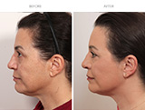Blepharoplasty 