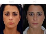 Blepharoplasty 