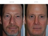 Blepharoplasty 