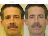 Blepharoplasty 