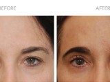 Blepharoplasty 