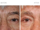 Blepharoplasty 