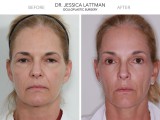 Upper and Lower Blepharoplasty and Endoscopic Browlift 4 Months Post Op.