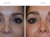 Blepharoplasty 