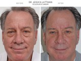 Lower Lid Blepharoplasty