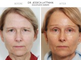 Endoscopic Brow Lift