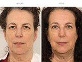 Endoscopic Brow Lift