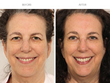Endoscopic Brow Lift