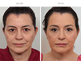 Endoscopic Brow Lift