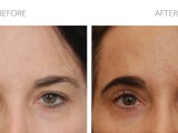 Endoscopic Brow Lift