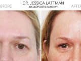 Endoscopic Brow Lift