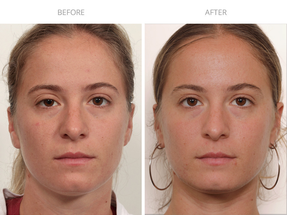 before and after surgery for Congenital Ptosis
