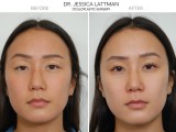 Right Eye Ptosis Repair