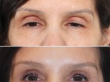 Ptosis Repair