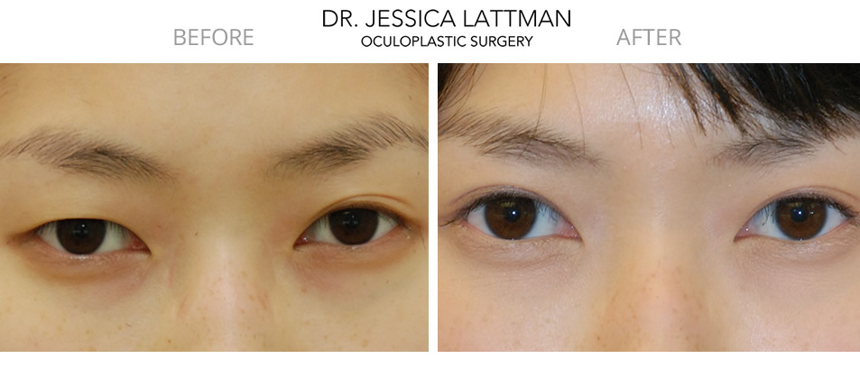 Asian Blepharoplasty New York