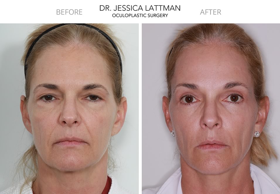 Blepharoplasty and Endocsopic Browlift NYC