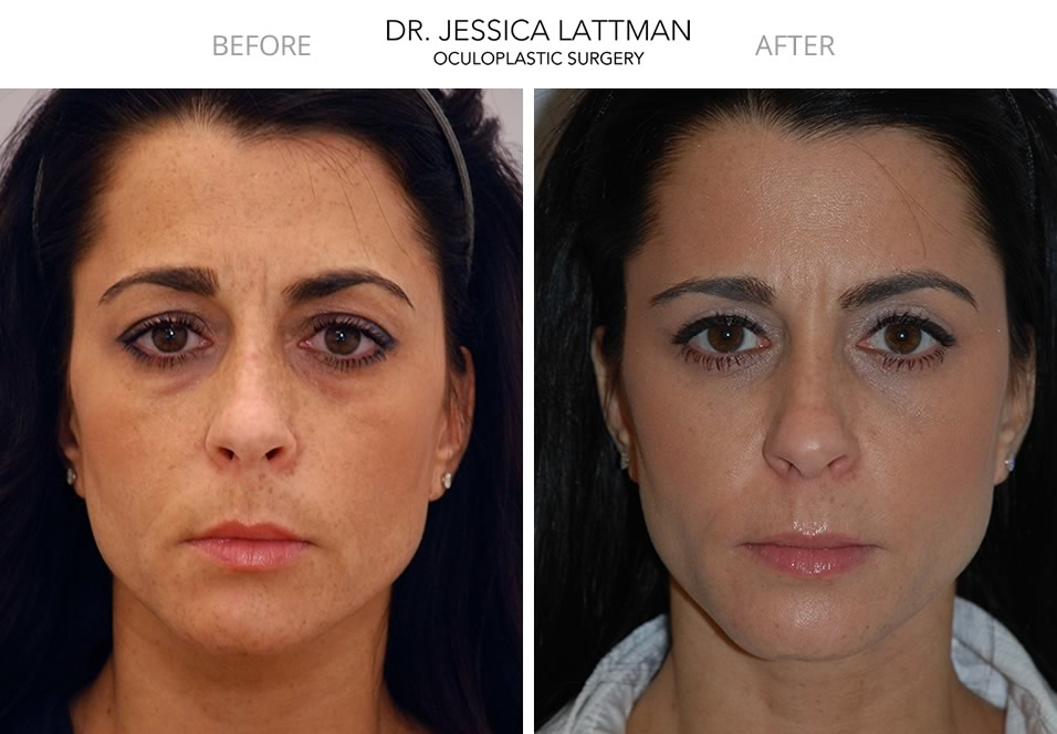 Female Upper Blepharoplasty by Dr. Lattman NYC