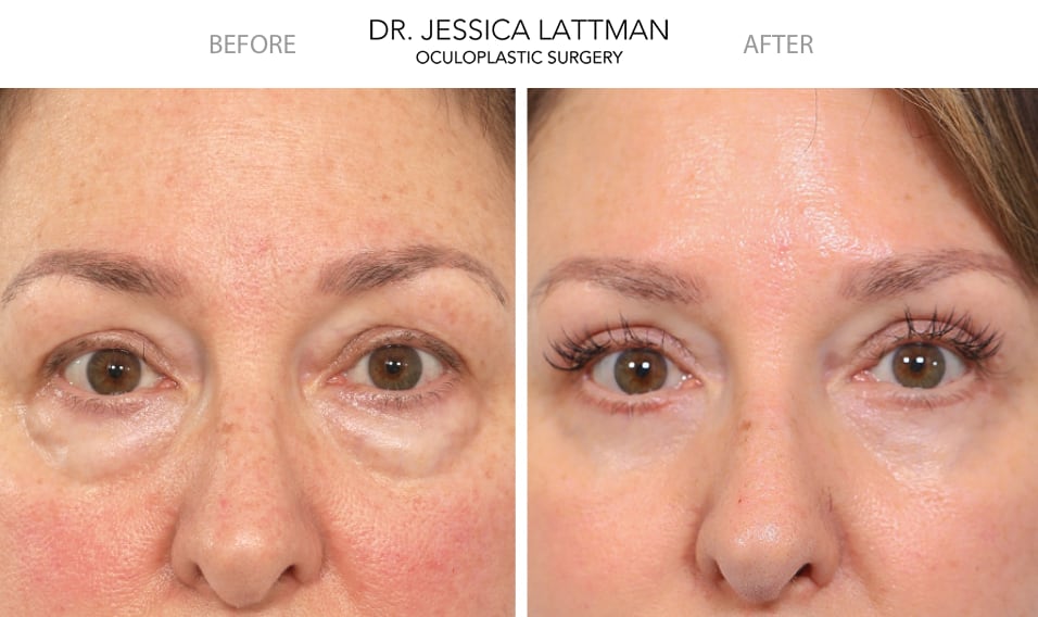 Best Lower Eyelid Surgery Austin, TX- Blepharoplasty | Under Eye Bag  Removal |