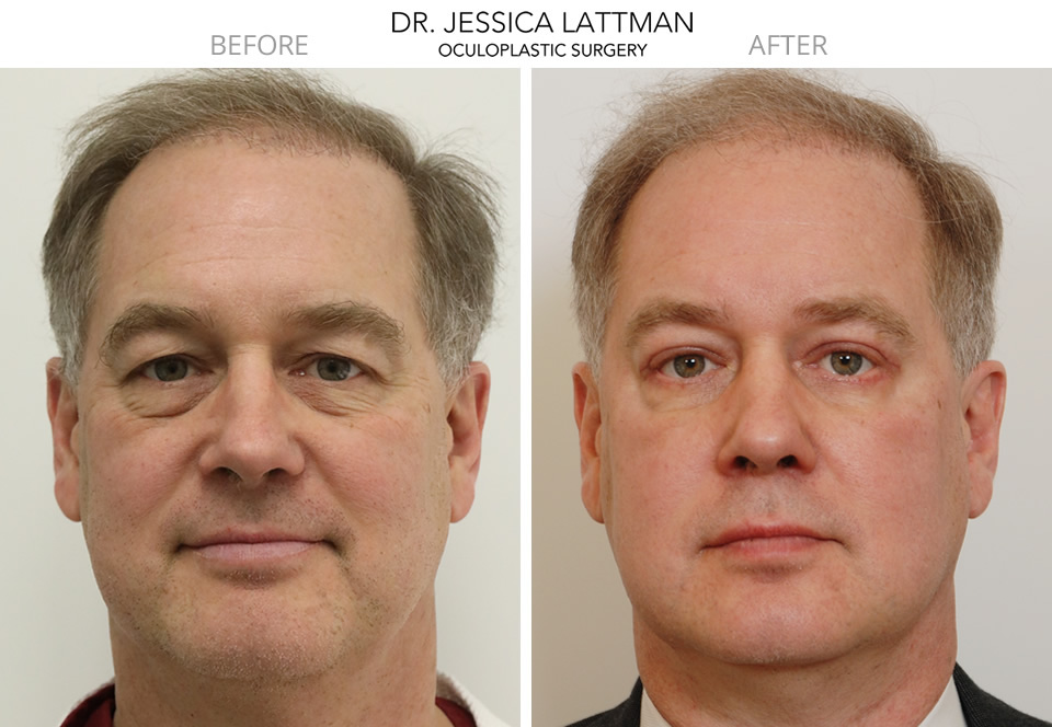 Male Lower Blepharoplasty by Dr. Lattman NYC