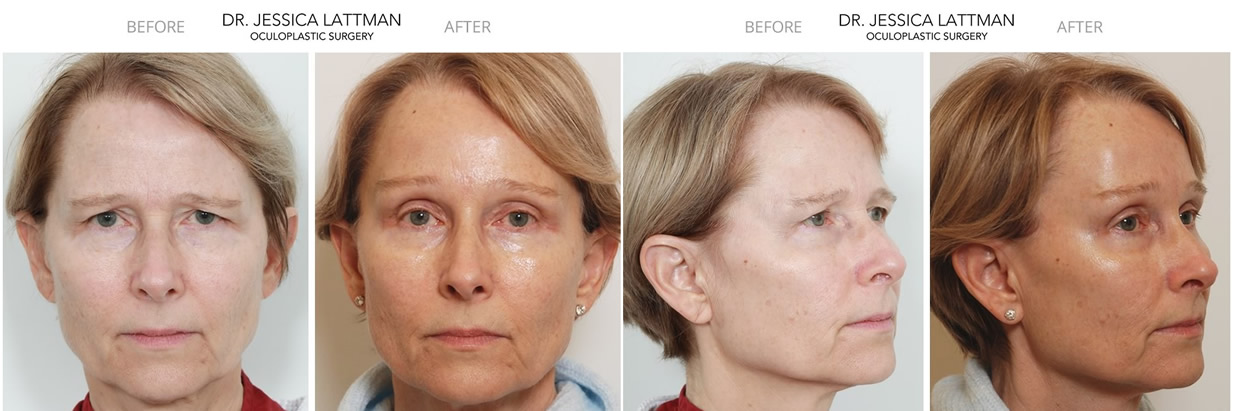 Upper Eyelid and Endoscopic Browlift NYC