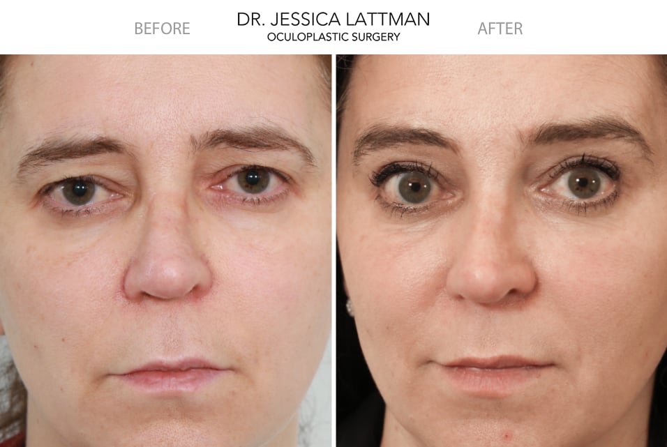 Female Brow Lift by Dr. Lattman NYC