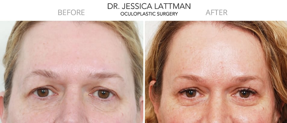 Female Blepharoplasty and Brow Lift  by Dr. Lattman NYC