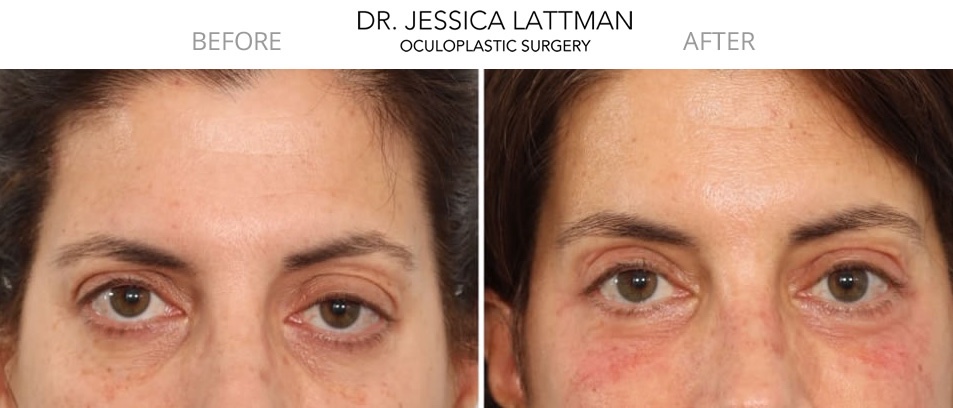 Female Brow Lift by Dr. Lattman NYC