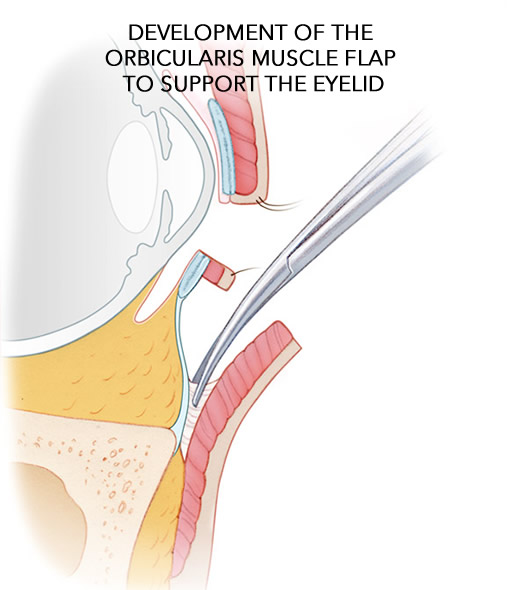 Eyelid Lower Blepharoplasty Surgery Image