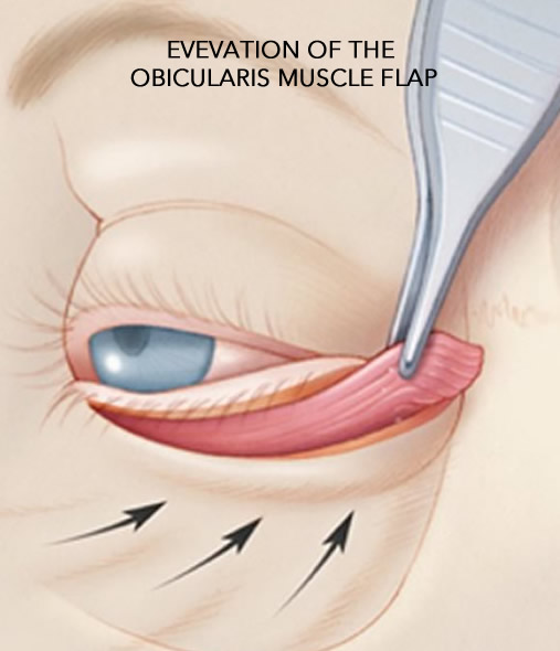 Eyelid Surgery Muscle Flap Image