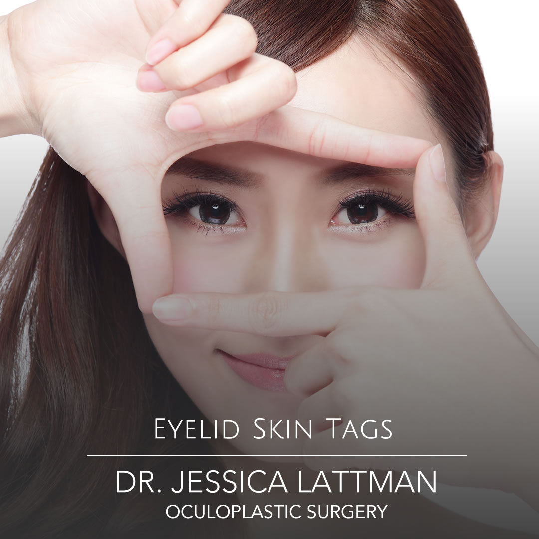 Eyelid Skin Tags