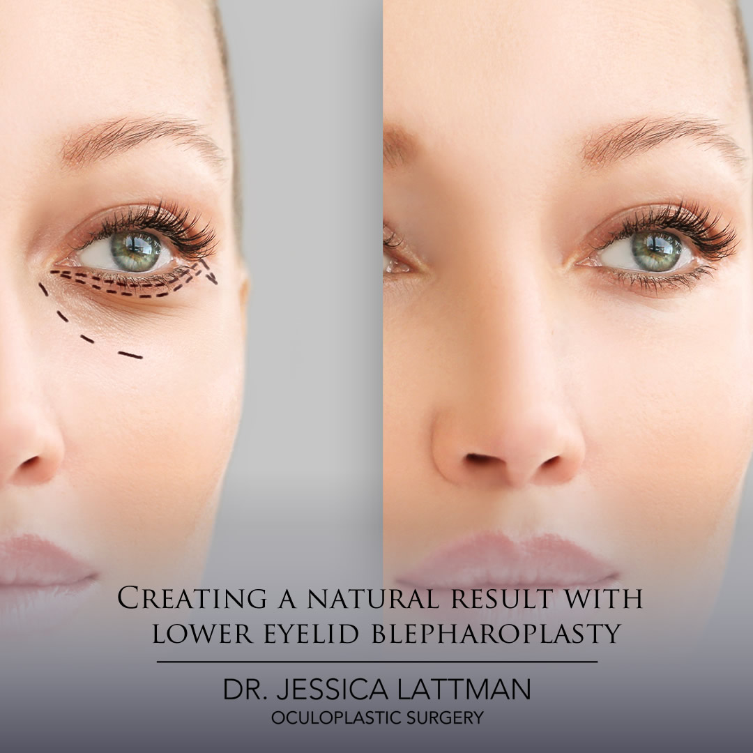 Creating a natural results with lower blepharoplasty