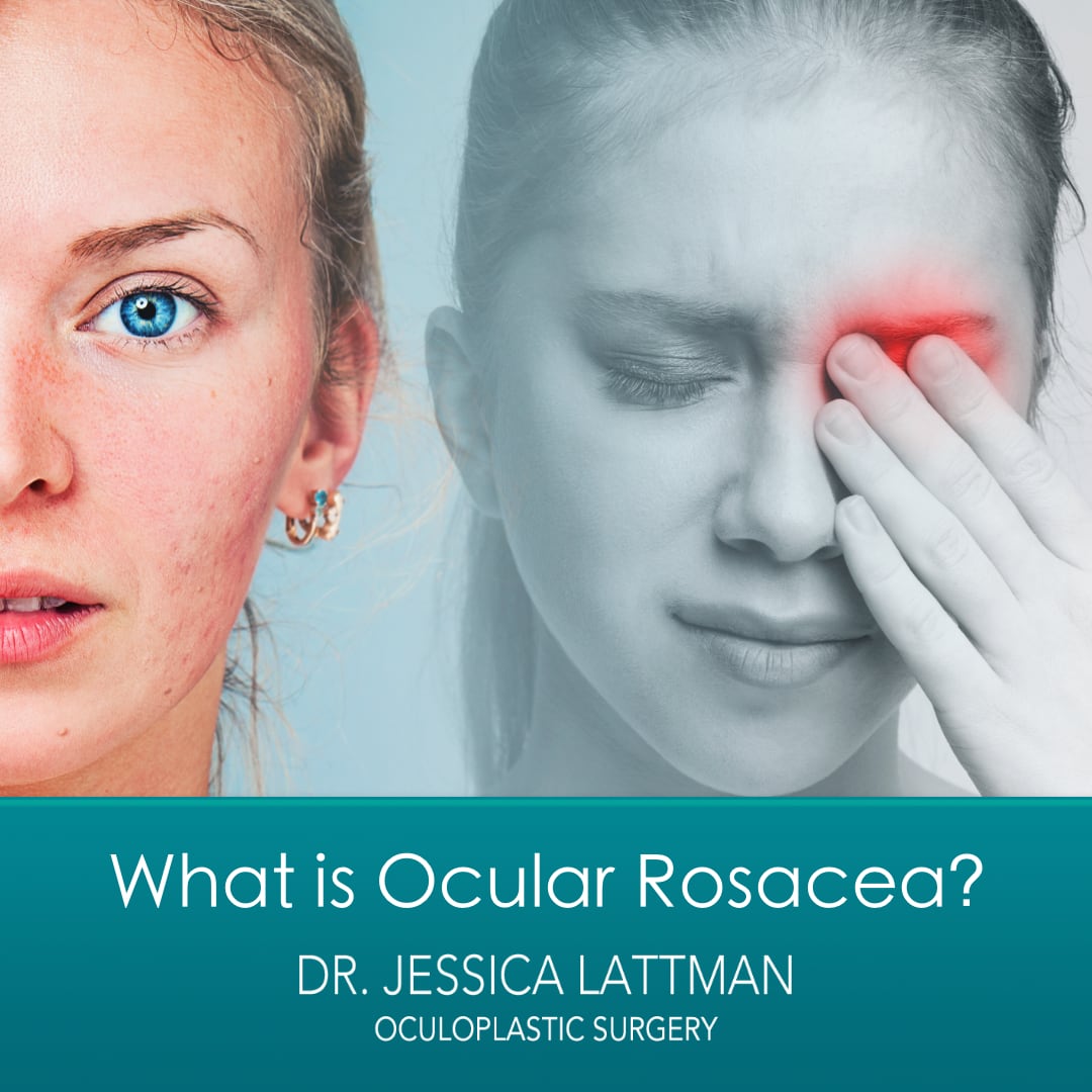 Ocular Rosacea NYC