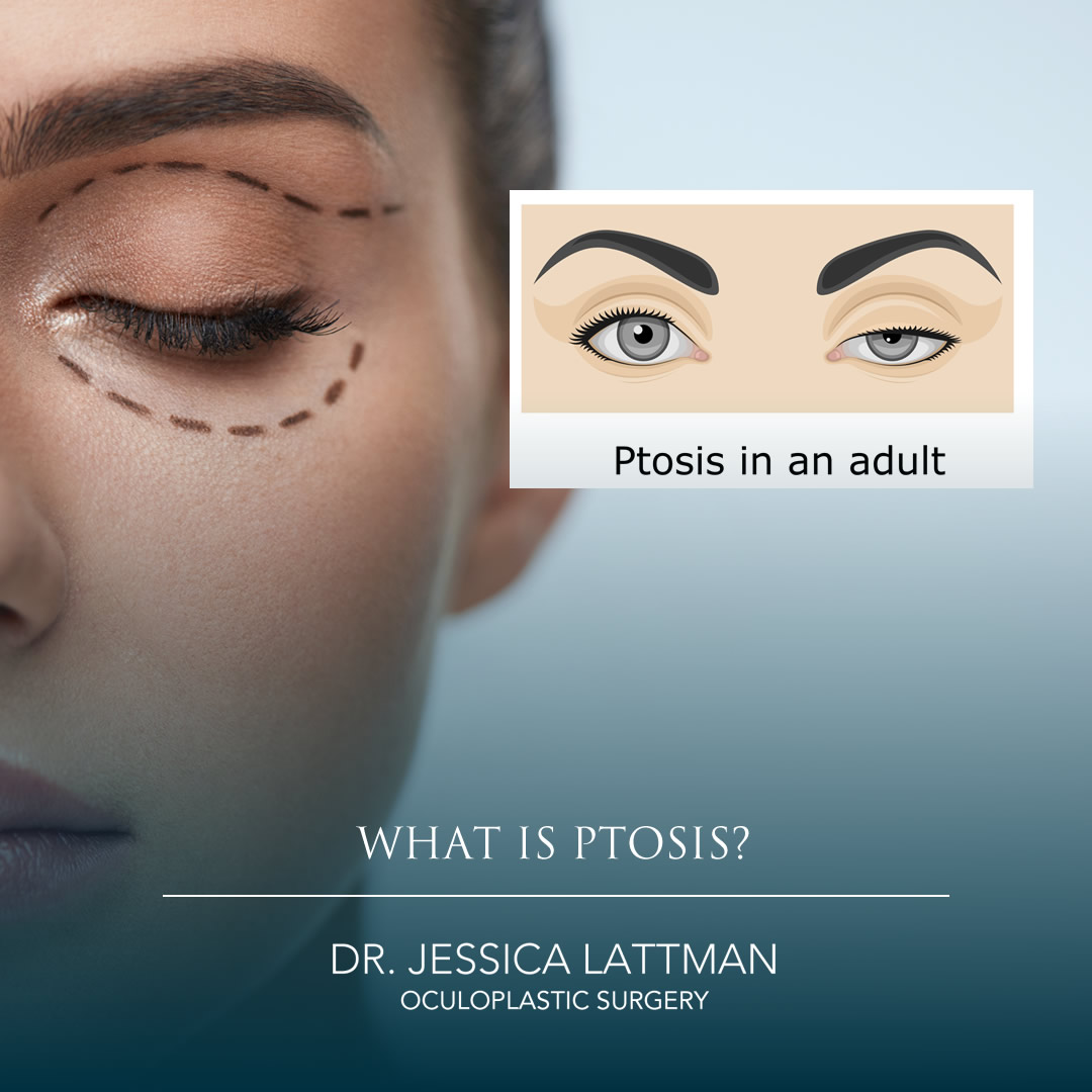 What is Ptosis?