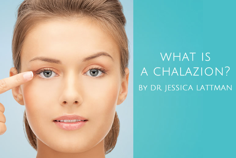 Chalazion