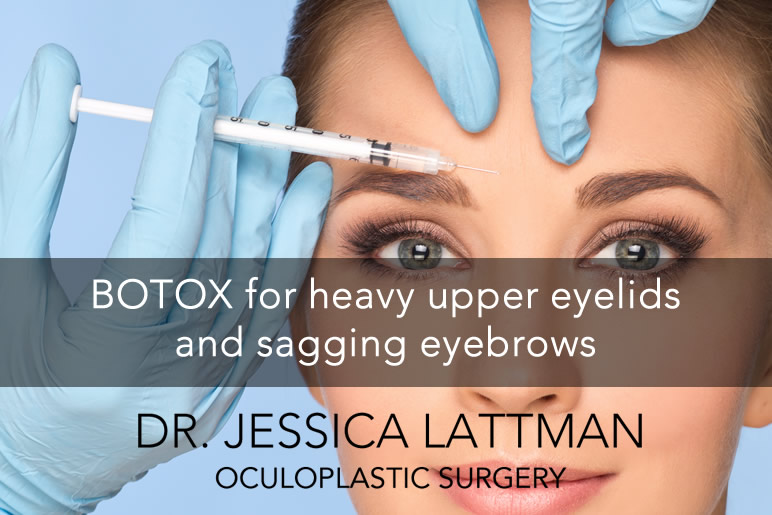 Botox for heavy upper eyelids and brows