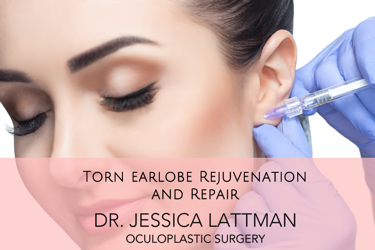 Torn Earblobe Repair by Dr. Lattman