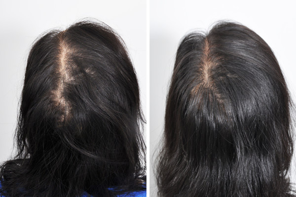PRP Therapy and Hair Restoration New York and Manhattan NYC PRP Therapy and Hair Restoration New York and Manhattan NYC