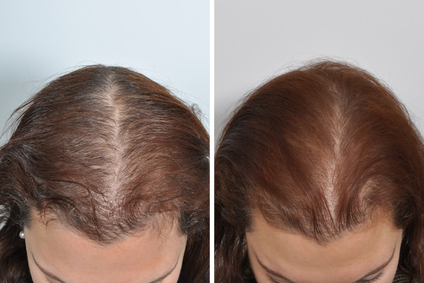 PRP Therapy and Hair Restoration New York and Manhattan NYC PRP Therapy and Hair Restoration New York and Manhattan NYC